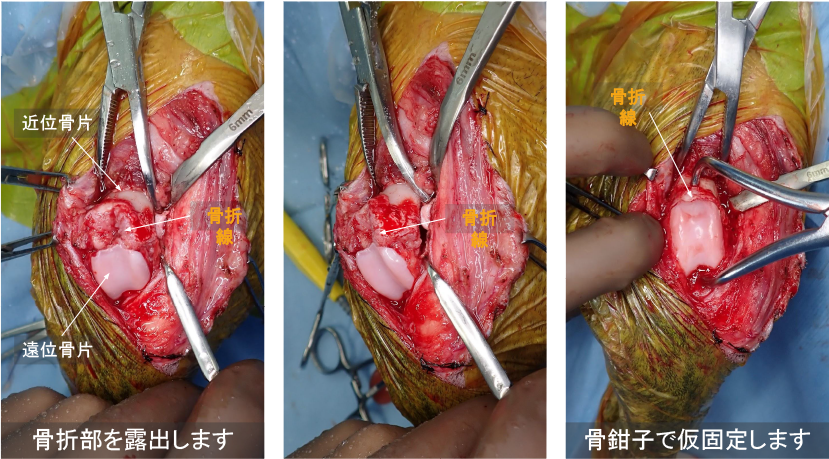 右側大腿骨遠位成長板骨折 術中所見01