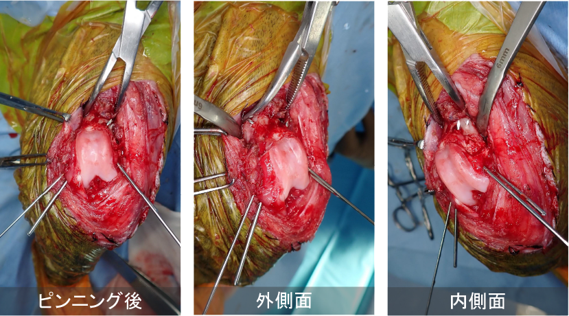 右側大腿骨遠位成長板骨折 術中所見02