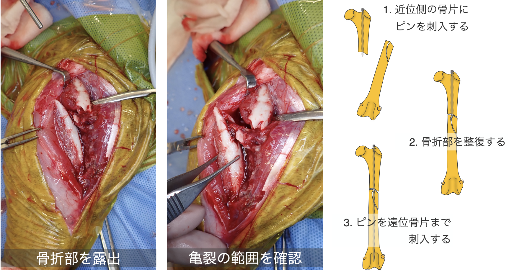 右側大腿骨骨幹部粉砕骨折 術中所見01