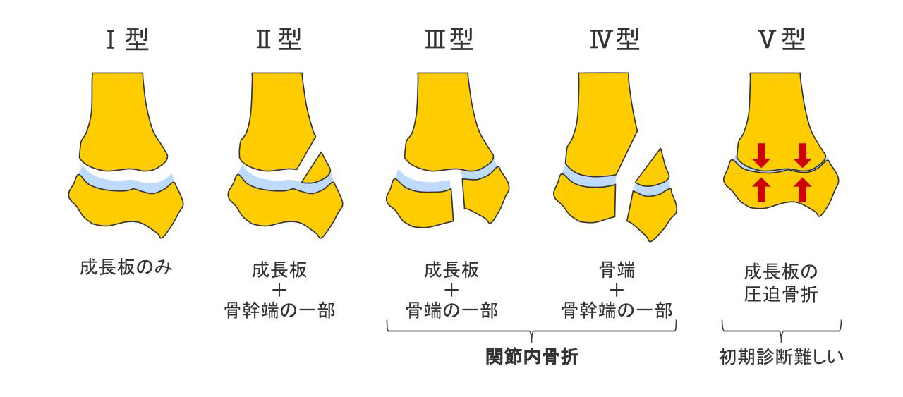 成長板骨折の分類イラスト